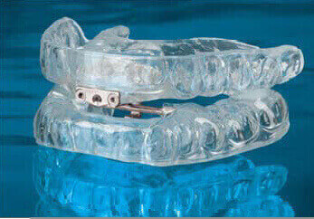 Oral Appliance and Sleep Apnea